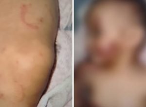 Bebe-de-7-meses-com-mordidas-causadas-pela-Mae-e-padrasto.jpg